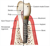 s_implant_08